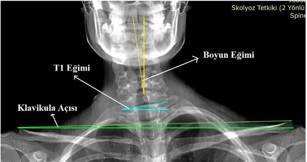 Şekil 3.1. Antero-posterior grafi üzerinden ölçülen parametreler.  