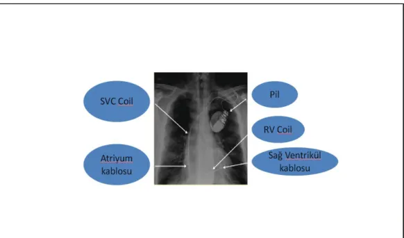 Şekil 2.5. ICD yerleşimi. 