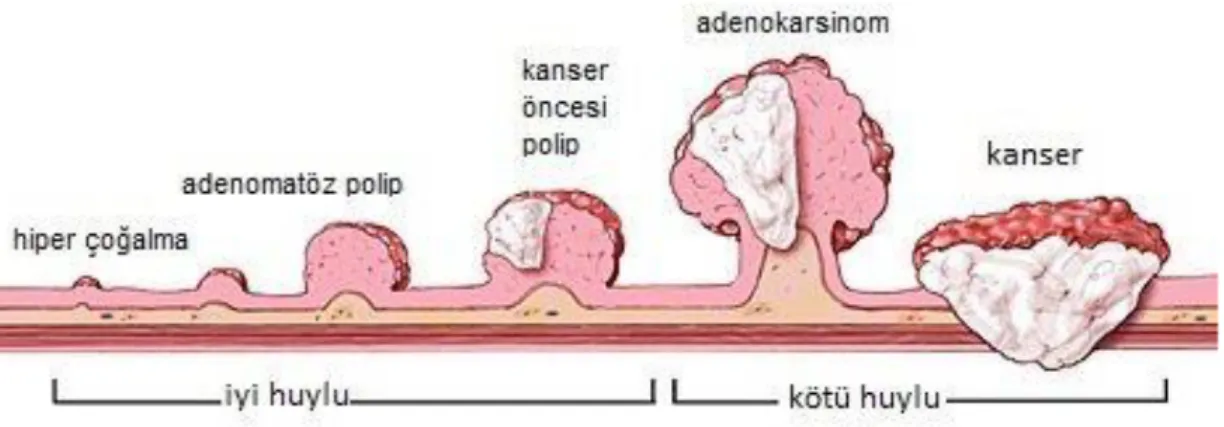 Şekil 2.1 Polip ve kanser gelişim süreci (12). 