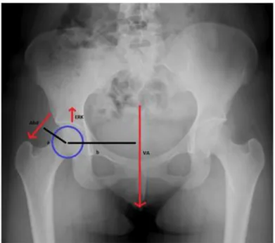Şekil 2.3. Kalça eklemine etki eden kuvvet ve kuvvet kolları (VA: Vücut ağırlığı, b:  Vücut ağırlığı moment kolu, Abd: Abduktör kaslar tarafından uygulanan  moment, a: Abduktör moment kolu) (27) 