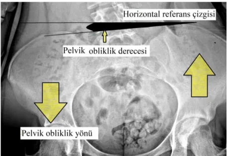 Şekil 2.13. Pelvik oblikliğin derecesinin ölçülmesi. 