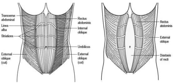 Şekil 2.6. Diastazis Rekti Abdominis (2).    Pelvis  