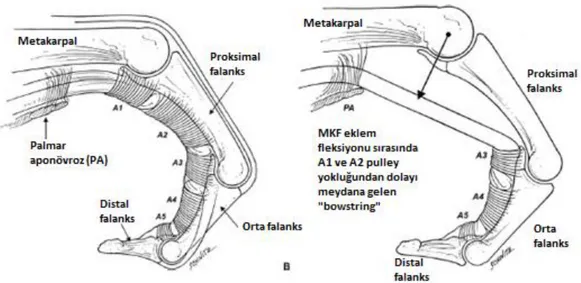 Şekil 2.10. A1 ve A2 pulleylerin yokluğunda oluşan tendon bowstringi (Ryzewicz ve 