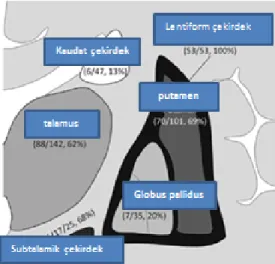 Şekil 2.3. Diskinetik serebral palsi’deki talamus ve bazal ganglion etkilenim dağılımı  (54)