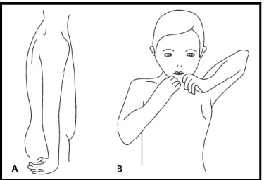 Şekil 2.5. “Trompet Sign” gösterilmiştir (59). 