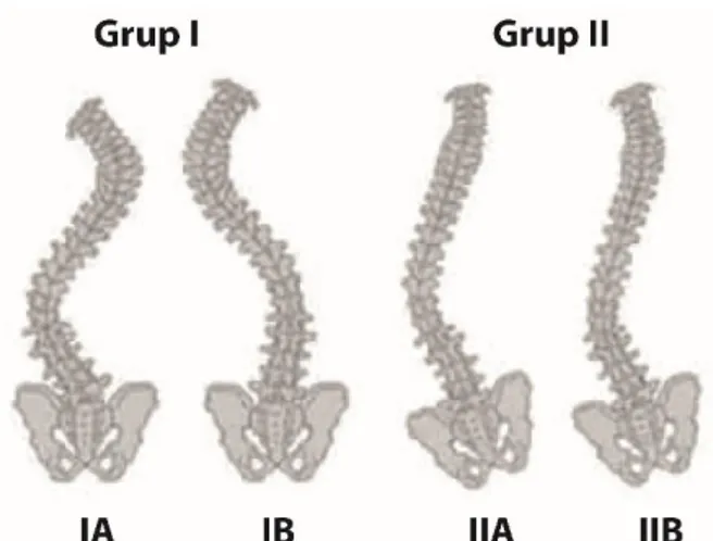 Şekil 2.3. SP’de Nöromüsküler Skolyoz ile İlişkili Spinal Deformite Paternleri (11). 