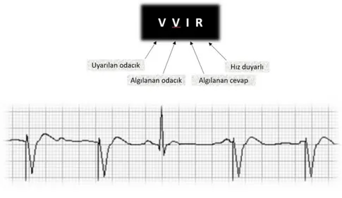 Şekil 2.5. VVIR modunda kalp pili EKG trasesi. 