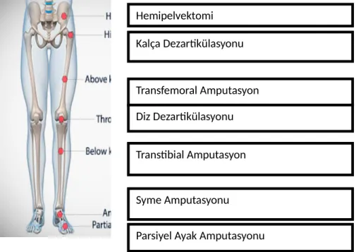 Şekil 2.1. Alt Ekstremite Amputasyon Seviyeleri