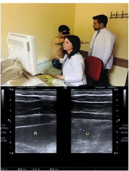 Şekil  3.7.  Dinamik  Pozisyonda  M.  Transversus  Abdominisin  Ultrasonografik  Görüntüleme ile Değerlendirilmesi ( R: Sağ Taraf, L: Sol Taraf, A ve B: M