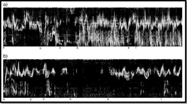 Şekil 2.6. Motiongram örnek görüntüsü a) Fidgety olan bebek, b) Absent fidgety olan  bebek (58) 