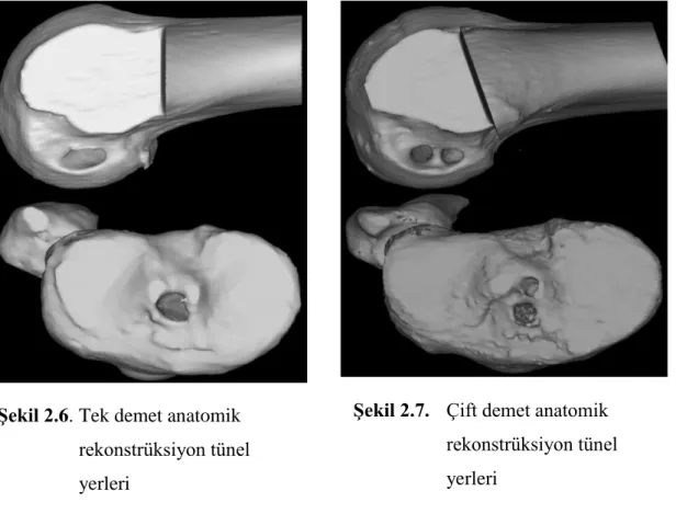 Şekil 2.7.   Çift demet anatomik 