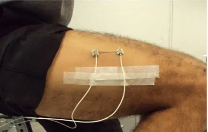 Figure 2.9. Example of the proximal and distal accelerometer placement on the  vastus lateralis muscle