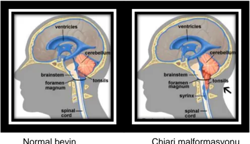 Şekil 2.5. Normal beyin ve Chiari malformasyonu (45)  