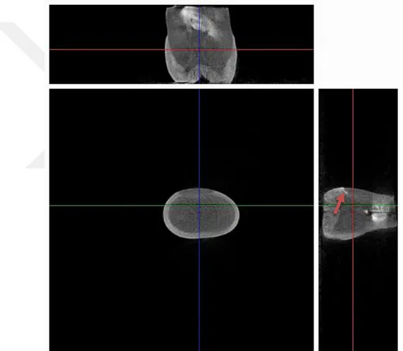Şekil 2.11 Papacarie ile tedavi edilen örneklerden birine ait mikro-CT görüntüsü.  Okluzal duvarda 2 (kırmızı ok), servikal duvarda 0 değerinde sızıntı izlenmektedir