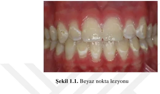 Şekil 1.1. Beyaz nokta lezyonu 