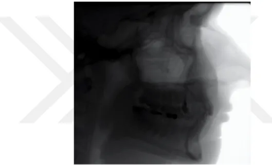 Şekil 2.2: KIBT’den elde edilen lateral sefalometrik radyografi görüntü