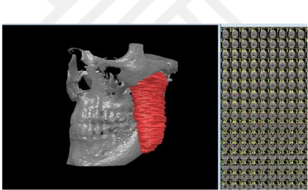 Şekil  2.4:  Masseter  kasının  3D-Doctor  ile  manuel  segmentasyon  yöntemi  ile  çizilmiş  3  boyutlu  görüntüsü 