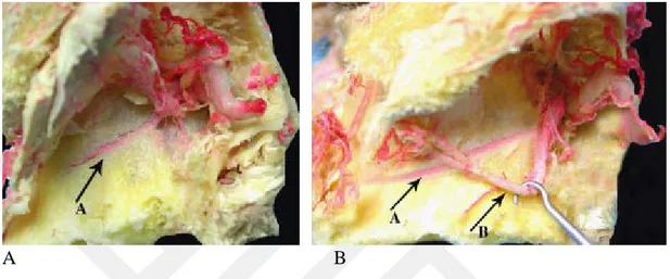 Şekil 2.3. Maksiller sinüsün görünümü. A: Alveol antral arter, maksiller sinüs lateral  duvarında  bulunan  posterior  superior  alveoler  arter  (PSAA)  endosseöz  dalı