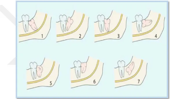 Şekil 1.3: Archer (1975) ve Kruger (1984)‘e göre gömülü yirmi yaş dişlerin gömülü  lük sınıflaması 1: Mezioanguler, 2: distoanguler, 3: vertikal, 4: horizontal, 5: 