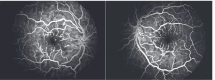 Figure 1. Bilateral cotton-wool spots concentrated in the posterior pole