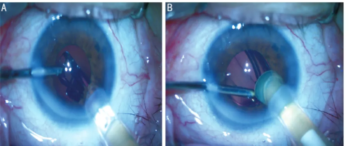 Figure 1 IOL hydroimplantation technique  A: IOL was introduced into capsular bag through the main corneal incision while the irrigation 