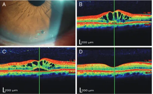 Figure 1B. Optical coherence tomography image showing cystoid macular oedema before medical treatment