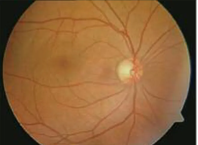FIGURE 2: Visual evoked potentials (pattern and flash) obtained from both eyes and were impaired in the right side.