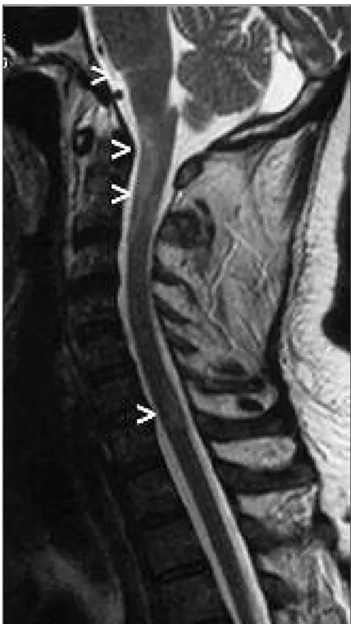 FIGURE 4: Pathologic signal enhancement in T2W spinal MRI at the level of brain stem, C1-3 and C6-7, indicating a demyelinating disease.