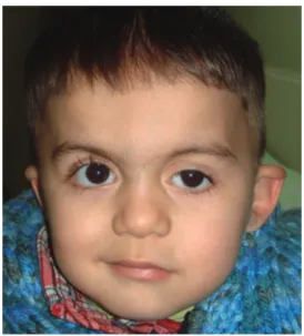 Figure 2. Sticky appearance of the right eye. External opening of lacrimal sac ﬁstula can be seen inferonasal to the medial canthus.