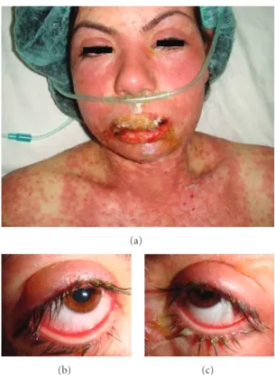 Figure 2: Ophthalmic examination at the fourth month presenting, (a, b) normal anterior segment features, (c) symblepharon  forma-tion in the lower fornix of the right eye.