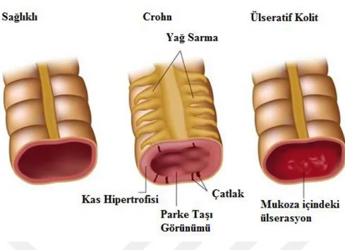 Şekil  2.  1.  Bağırsağın  normal  sağlıklı  bireylerde,  Crohn  hastası  ve  ülseratif  kolit  olanlarda anatomik temsili olarak gösterimi (Alila MedicalMedia/Shutterstock.com)  Crohn hastalığı ilk olarak İtalyan Fizikçi GiovanniBattistaMorgagni tarafında