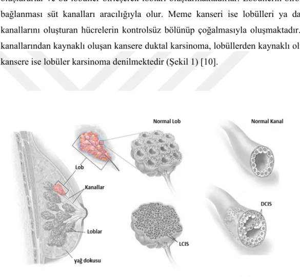 Şekil 1. Meme Yapısı, LCIS ve DCIS oluşumu [150]