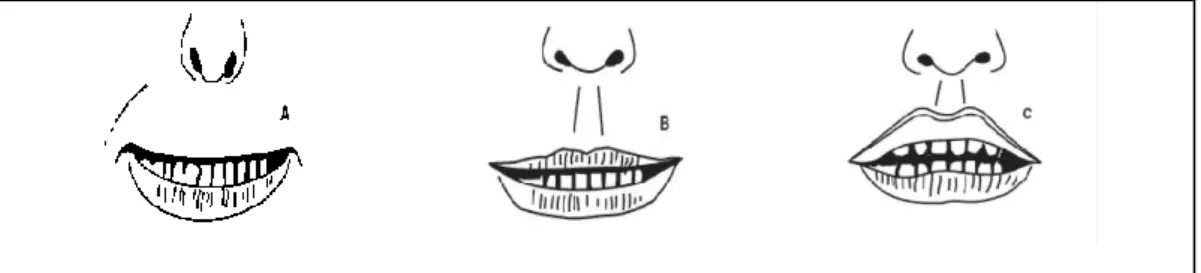 ġekil 3: Üst dudak ısırma testinin Ģematik görünümü ( A: Sınıf 1, B: Sınıf 2,  C: Sınıf 3) 7 