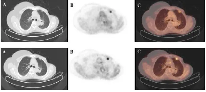 Şekil 4. 70 yaş  kadın hastaya ait PET/BT görüntüleri.  