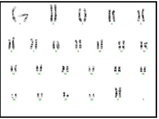 Şekil 3: Translokasyon tipi Down Sendromlu bir hastanın sitogenetik görüntüsü  (46,XX t(21;21) ) 