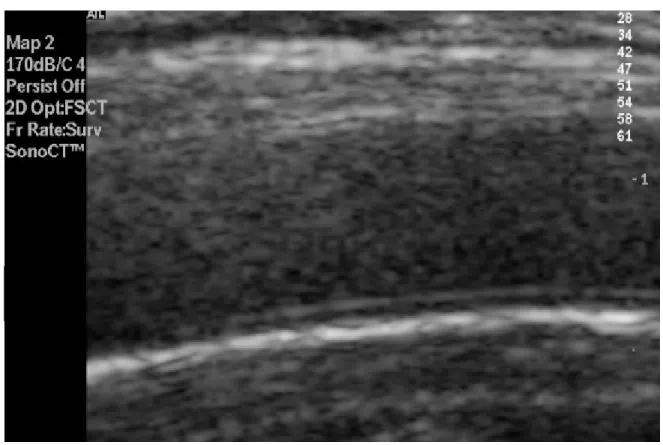 Şekil 1. Ana karotid arter düzeyinde  intima medianın ultrasonografik görüntüsü 