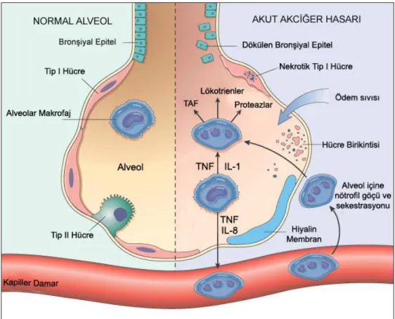 Şekil  4:  Akut  Akciğer  Hasarında  hasarlı  alveol  ile  normal  alveolün  (sol  taraf) 