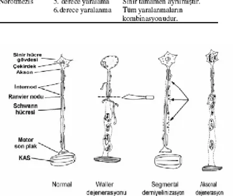 Tablo 1. Periferik sinir yaralanmalarında sınıflama (13) 