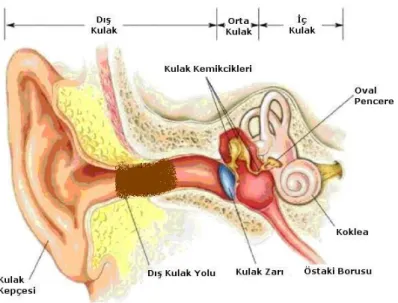 Şekil 1: Dış Kulak Yolunda Buşon Görünümü 