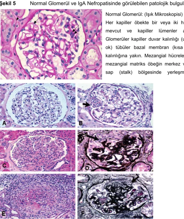Şekil 5  Normal Glomerül ve IgA Nefropatisinde görülebilen patolojik bulgular* 