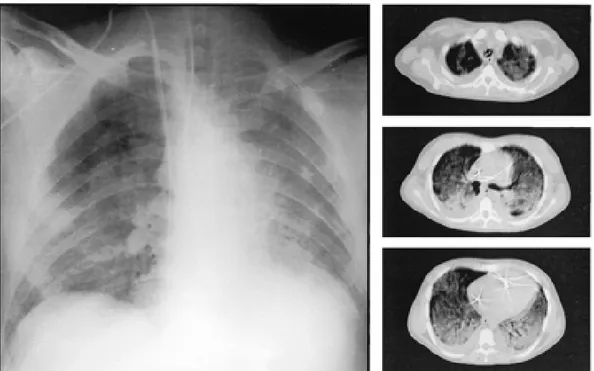 Şekil 1: ARDS radyoloji bulguları 24 saat içinde hızlı progresyon ve  bilateral akciğere yayılım gösteren radyoopasiteler 