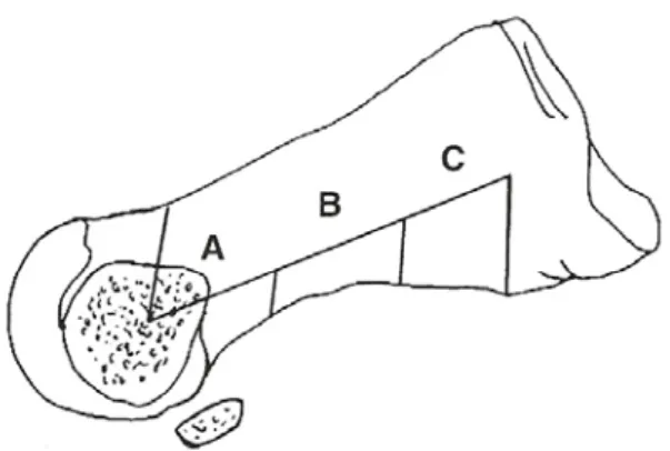 Şekil 17: Kısa, orta ve uzun scarf osteotomisi 