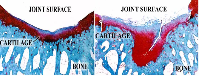 Şekil 4. Normal kartilaj ve osteoartritik kartilaj 