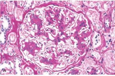 Şekil  7.  IgA  nefropatili  bir  hastanın  glomerülü.  Mezangial  selülerite  ve  matrikste  orta  derecede  artış 