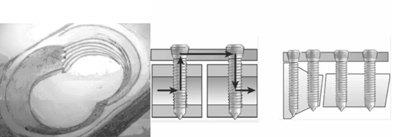 Şekil  10:  Kilitli  kompreyon  plağının  vida  deliğinin  görüntüsü.  LCP  plak  yük  aktarımının  şematik 