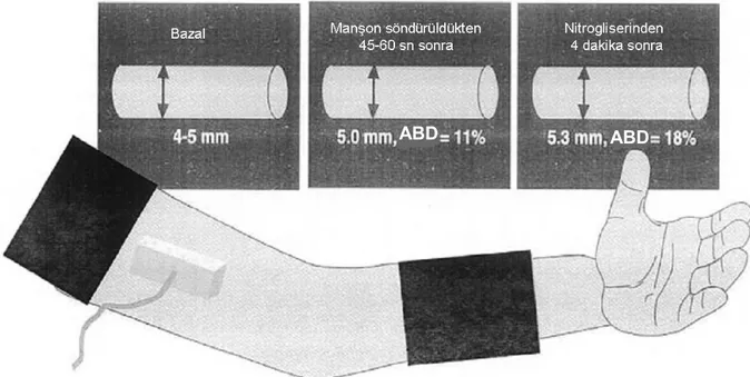 Şekil 6. Brakiyal arterin akıma bağımlı vazodilatasyon yöntemi ile değerlendirilmesi