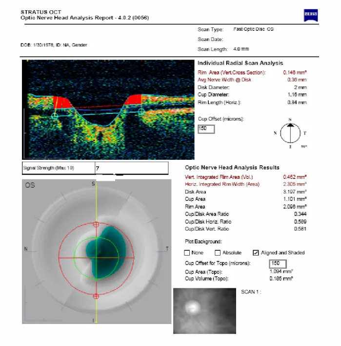 Şekil 2: Stratus OCT ile fast optik disk modunda optik sinir başı  analizi 