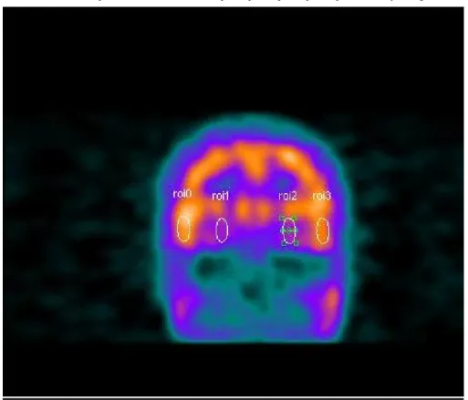 Şekil 2: Temporal kesitler üzerinde parahippokampal gyrus (hipokampal alanıda içeren)  ve gyrus temporalis lateralis alanlarına manuel olarak çizilen ilgi alanı (121) 