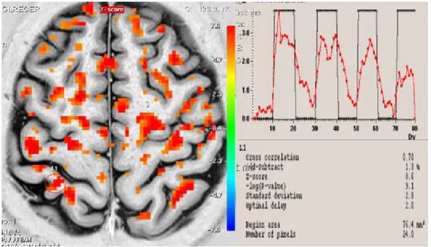 Şekil  6.  Olgu  1’in  düşük  frekanslı  TENS  uygulamasından  sonra  yapılan  fMRG’sinde  kontralateral  S1(kırmızı  halka)’deki  azalmış  aktiviteyi gösteren  fMRG kesiti,  sinyal eğrisi  ve Z skoru değeri 