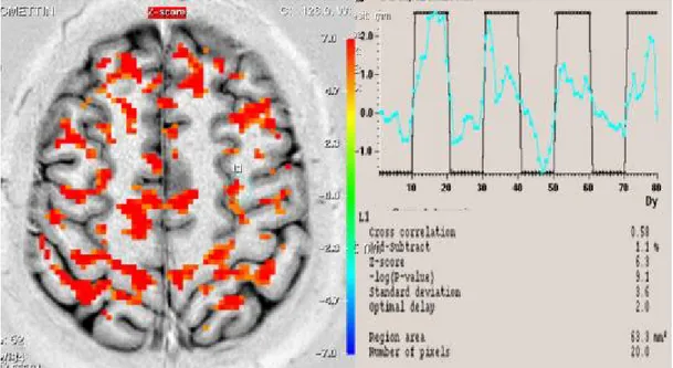Şekil 12. Olgu 3’ün düşük frekanslı TENS uygulamasından sonra yapılan fMRG’sinde  ipsilateral  kaudal  ACC  (yeşil  halka)’deki  azalmış  aktiviteyi  gösteren  fMRG  kesiti,  sinyal  eğrisi ve Z skoru değeri 